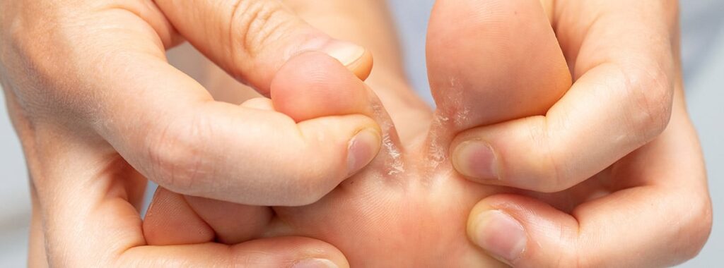 hongos en los pies entre los dedos pie de atleta