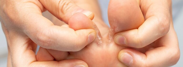 hongos en los pies entre los dedos pie de atleta